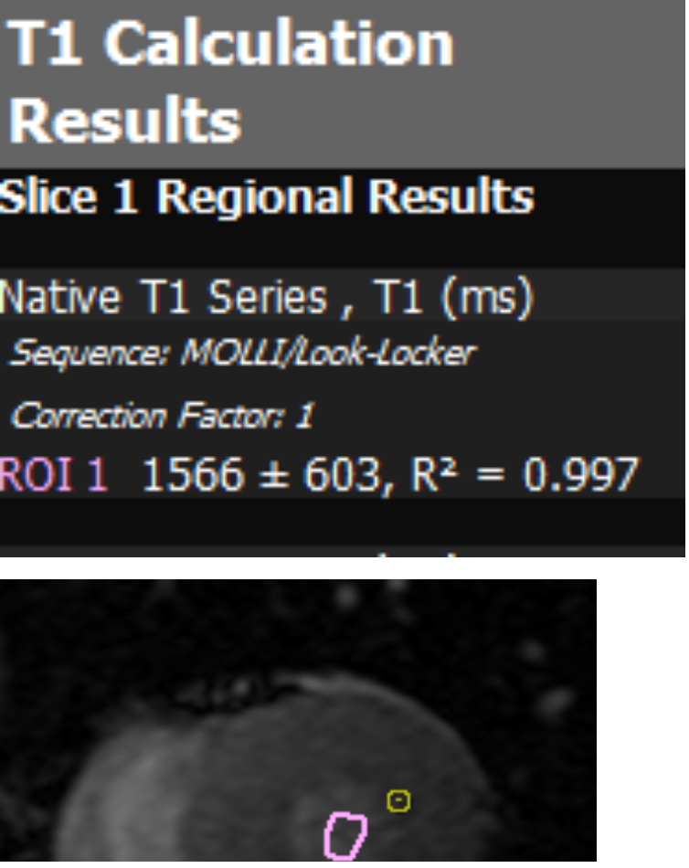 CVi42 T1 Calculation Results: ROI 1 native T1 1566 ± 603 ms, R² = 0.997, with short-axis MRI showing pink blood-pool ROI.